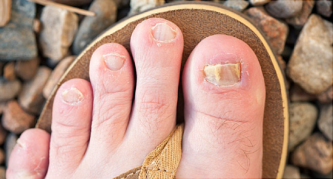 Common foot problems and how to treat them